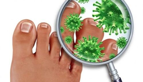 Fungus nail