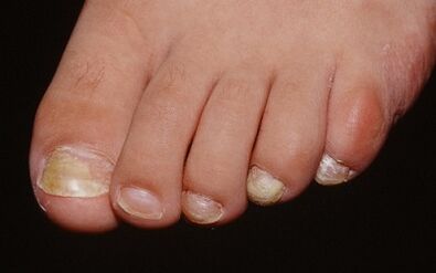 Reasons Appearance Fungi on the thumb leg