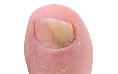 Symptoms of the presence of fungus on the thumb leg