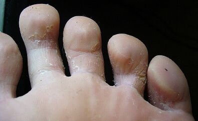 What does the fungus on your feet look like and how to treat