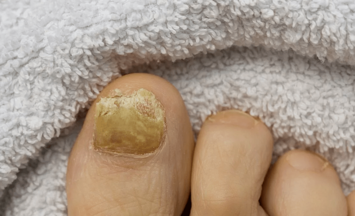 Fungus nail