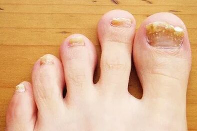 Fungus nail