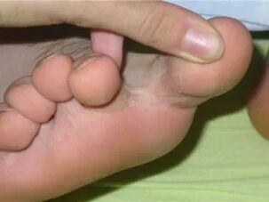 The toes itch
