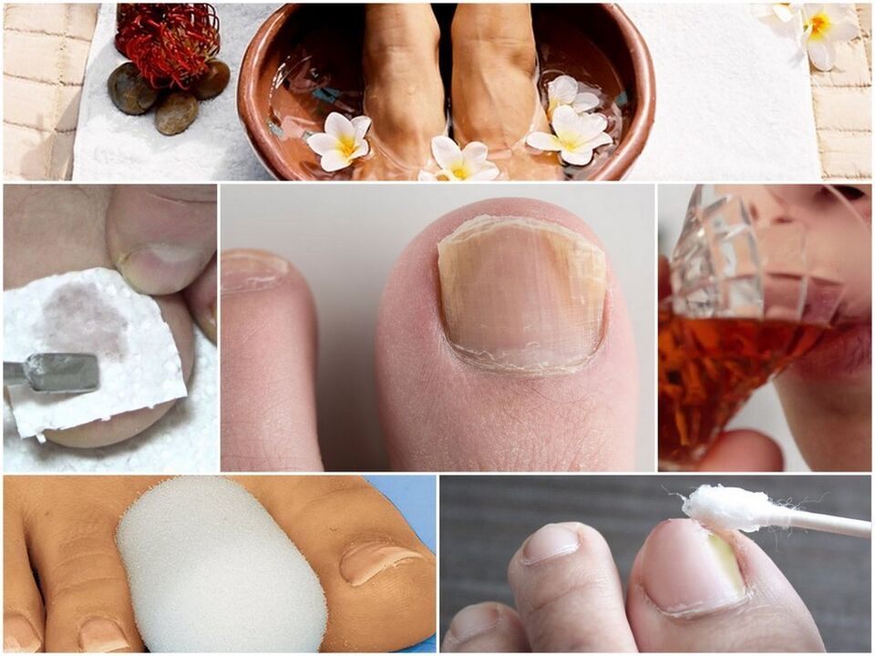 Fungus treatment for nails