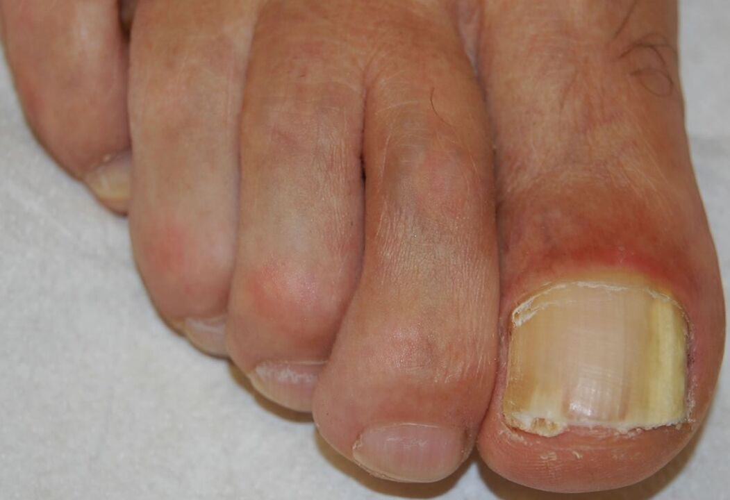 Distal-lateral subungual onychomycosis on the leg